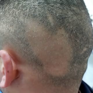 🔬✨ Alopecia Areata: ¡Sí se puede! 

Hoy queremos compartir un caso muy especial: un paciente con al