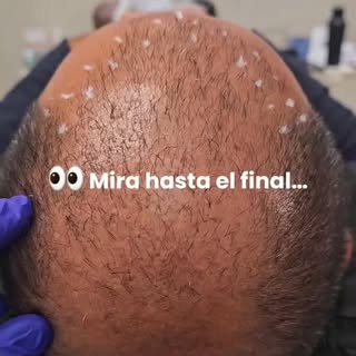 Primera sesión… y mira ese cambio 🔥👀
Todavía falta completar el proceso, pero desde la primera ses