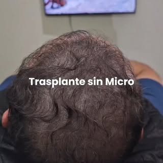 Más densidad. Más definición. Mejores resultados. 💥
La micropigmentación capilar ayuda a crear una 