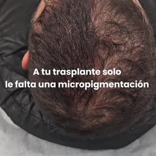 ¿Ya te hiciste un trasplante capilar pero todavía no tienes la densidad que deseas?
La micropigmenta