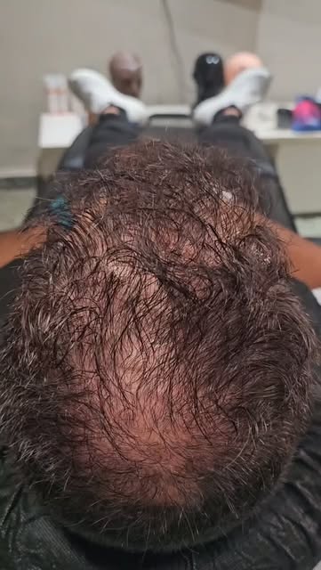 🔥 2 sesiones. Una transformación increíble.

Más densidad. Más definición. Resultado natural. 💯

�