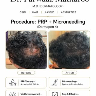 Hair fall isn’t a one-size-fits-all problem, so the treatment shouldn’t be either.

✨ PRP + Micronee