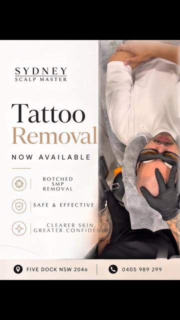 ✨ SMP LASER TATTOO REMOVAL — A FRESH START FOR YOUR HAIRLINE ✨

Do you have old, botched, too dark, 
