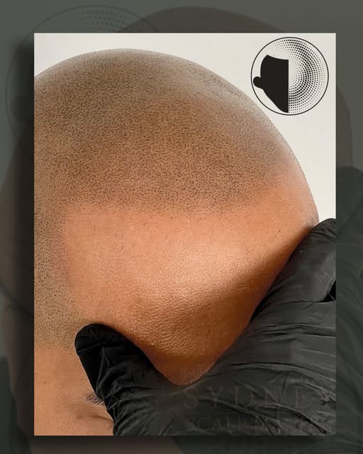 🔥 SMP THAT DOESN’T LOOK LIKE SMP.

Soft. Subtle. Undetectable. 👌

At Sydney Scalp Master, we belie