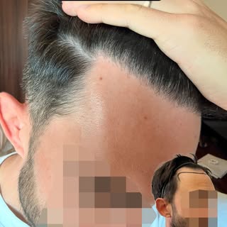 Six months in, and this hairline is looking exactly as nature intended! 🌟 The beauty of a well-done