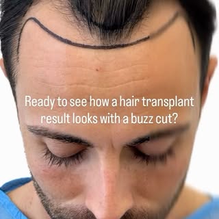 Buzz cut. Zero cover-up.
When the angles, direction, and density are done right, the result should l