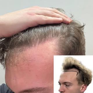 12 months post-FUE ✨
2,539 grafts restored to the hairline, designed with a soft, feathered edge for