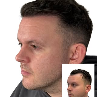 Another beautiful, feathered and natural hairline transformation

The FUE Hairline transplant used 2