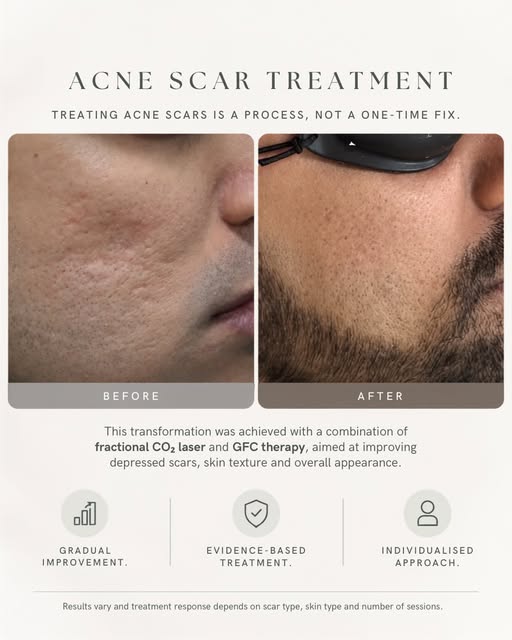 Acne scar treatment is a journey, not an overnight transformation. ✨

This result was achieved with 