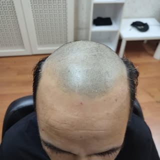 HDC ANKARA doğallığın adresi.Uzmanlarımızla birlikte saç sorunlarınıza beraber çözüm bulalım.
📞0312