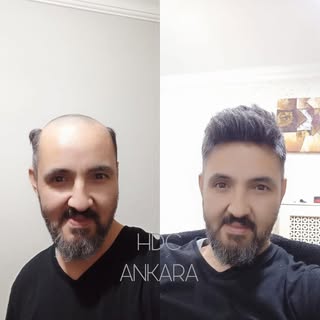 Saç, erkek imajını tamamlayan en önemli şeydir! Saç dökülmesi sorununu kader olarak kabul etmeyin. S