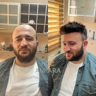 Saç, erkek imajını tamamlayan en önemli şeydir! Saç dökülmesi sorununu kader olarak kabul etmeyin. S