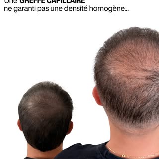 🍃 La greffe capillaire a ses limites.

Une greffe permet de restaurer une implantation et d’apporte