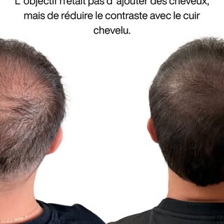 🔍 La greffe et la micropigmentation poursuivent deux objectifs différents, mais parfaitement complé