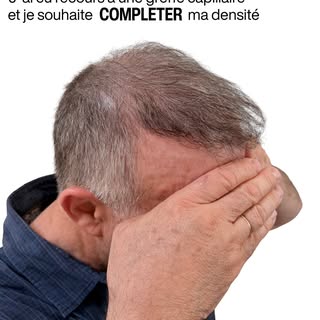 Une greffe capillaire peut transformer une chevelure… mais elle ne permet pas toujours d’obtenir la 