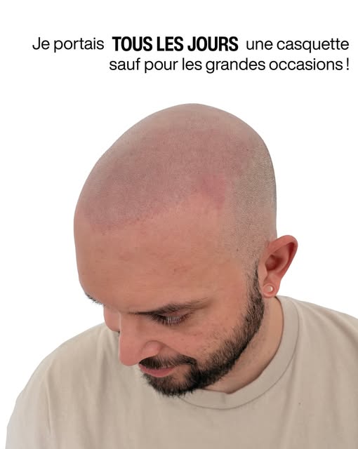 « Aujourd’hui, je n’ai plus rien à cacher »

La micropigmentation capillaire ne lui a pas simplement