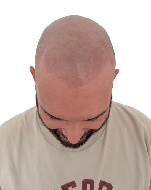 Le but ? 
Que personne ne se pose la question !

Recréer visuellement l’apparence de follicules rasé
