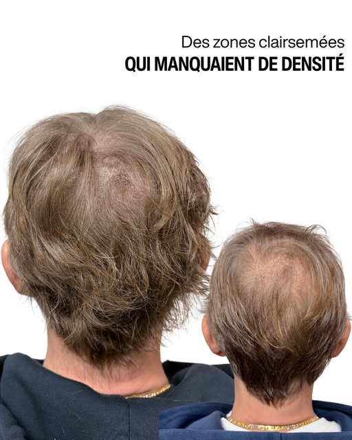 Le vertex est souvent l’une des zones où la perte de densité devient la plus visible.

Lorsque les c