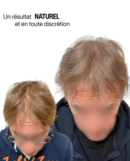 Quand les cheveux sont toujours là, mais que le cuir chevelu devient trop visible.

La micropigmenta