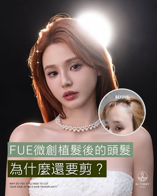 植髮後長出來的頭髮，是不是會永遠維持同一個長度？
答案是：不會，它會像原本的頭髮一樣繼續生長！
​
植髮並不是把假髮或現成髮絲「種」進頭皮，而是將自己後枕部較健康的毛囊，移植到髮際線、額角或頭頂等落髮
