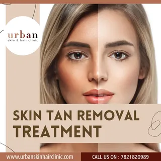 Skin Tan Removal Treatment.
Urban skin & hair clinic.
www.urbanskinhaiclinic.com
Book your Appoint