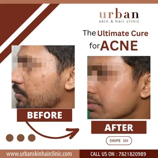 GET RID OF YOUR ACNE WITH GLYCOLIC ACID PEEL TREATMENT
In the forever battle against acne, blackhea