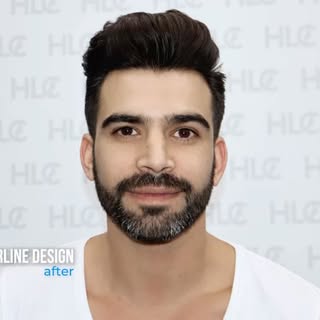 Hairline transplantation case❕

The hairline was designed in harmony with the patient’s facial propo