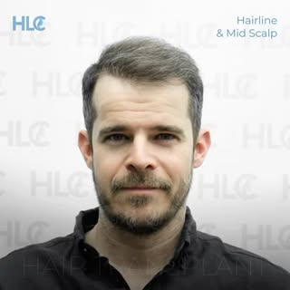 Hairline & Mid-Scalp Restoration

Using the manual FUE technique, 4,301 grafts were transplanted to 