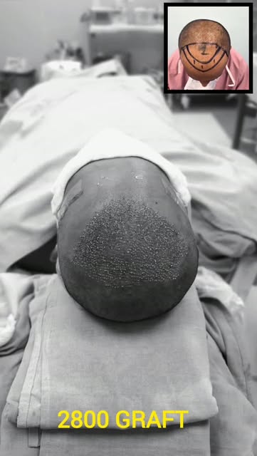 2800 Grafts | Hair Transplant Journey ✨
A carefully planned hair transplant with 2800 grafts, design
