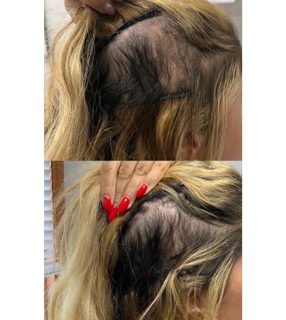 HAIR PRP FOR ALOPECIA

Hair PRP (Platelet-Rich Plasma) is a regenerative treatment that uses a conce