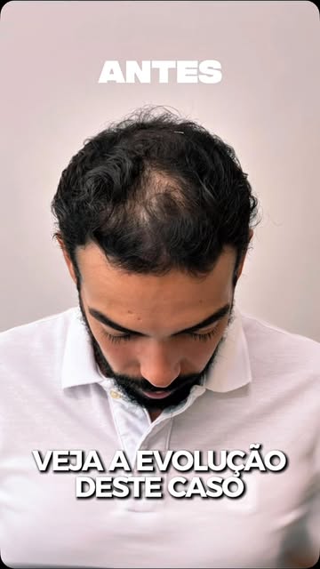 Nem toda calvície precisa de cirurgia para ser vencida. 

Veja a evolução!!! Com um planejamento ind