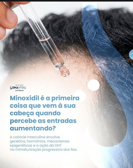 A alopécia androgenética é resultado de uma interação complexa entre predisposição genética, fatores