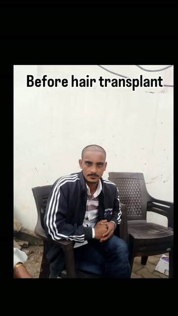 Hair transplant result