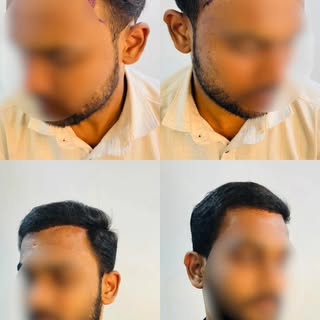 💇‍♂️ Balding isn’t the end — it’s a new beginning!

Watch how a simple hair transplant can transfor