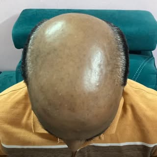 From Balding to Bold — My Hair Transplant Journey at PVR Aesthetica

I was tired of hiding, avoiding