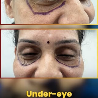 ✨ “You look so tired” – ever heard that even after a full night’s sleep?

Under-eye hollows can make