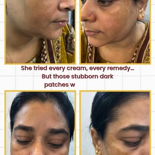 ✨ Stubborn dark spots? It’s time to say goodbye! ✨

From countless creams to real results — Pico Las