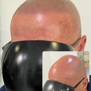 Natural Scalp Micropigmentation results🔥
Once redness and impressions heal - his SMP hair tattoo wi