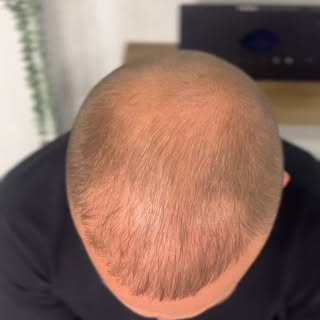 Had a hair transplant… but still not happy with the density?

This client came from the UK🇬🇧 after