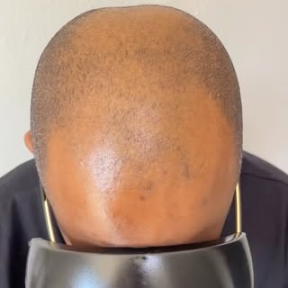 Hair loss can affect more than just your appearance, it can impact your confidence too.

This client