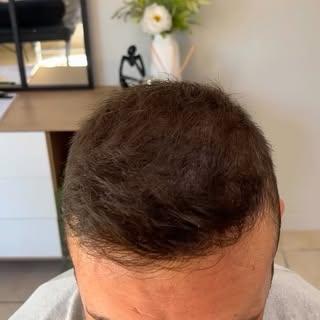 Hair transplants restore hair. Scalp Micropigmentation restores the appearance of density. When comb