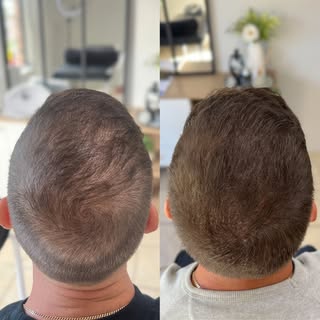 Scalp Micropigmentation Density Transformation🔥

Book a free consultation to get your tailored trea