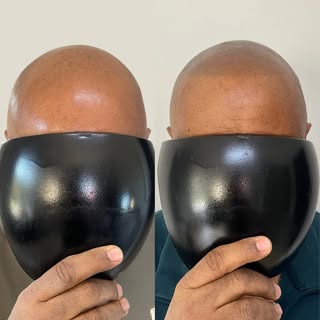 Natural results, Thoughtfully designed🖊️

Scalp Micropigmentation is more than placing dots, it’s a