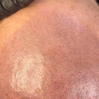 This is what scalp micropigmentation looks like immediately after a session🔍

Redness is completely