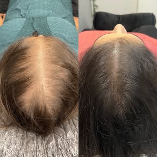 More confidence. More ways to wear your hair. 🤍

Density SMP reduces the appearance of visible scal