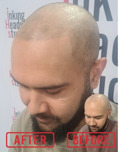 FROM THIS ➡️ TO THIS 🔥

The Inking Heads transformation.

No surgery. No hiding. Just a sharper, mo