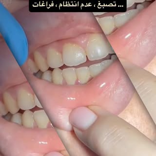 ⁨	القرار الذي لن تندم عليه … إبتسامتكً تعبّر عنك 
للاتصال 0797043538 
مركز أميمة الطبي #أسنان #فينير