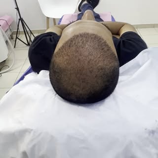 اليوم ١١ بعد #زراعة_الشعر في مركز أميمة الطبي …هكذا يكون التشافي الممتاز عند  تتم العملية بشكل إحترا