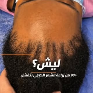 سبب فشل #زراعة_الشعر #الكيرلي.
#الاردن
