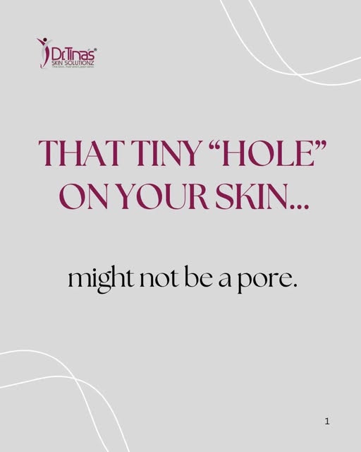 That tiny “hole” on your skin might not be a blackhead.

A Dilated Pore of Winer is a benign, enlarg